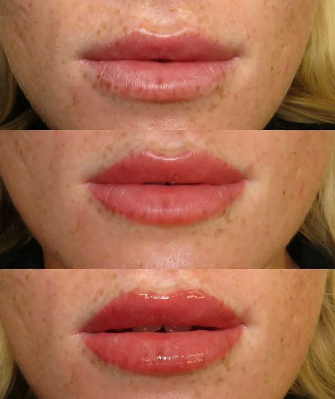 Aftercare to Avoid Cold Sore Outbreaks